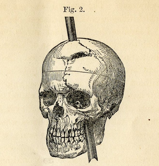 phineas-gage-skull-1